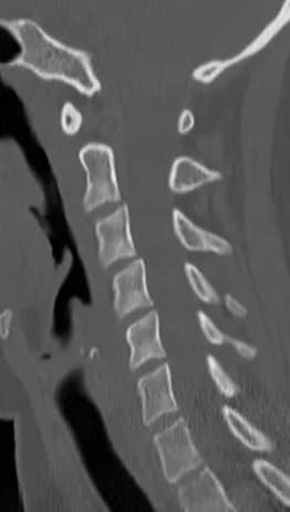 Sagittal CT of the cervical spine
