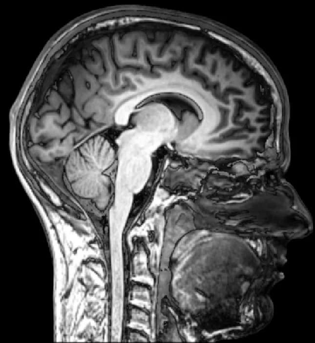 Sagittal MRI of the head showing the brain, cerebellum, brainstem, and cervical spine