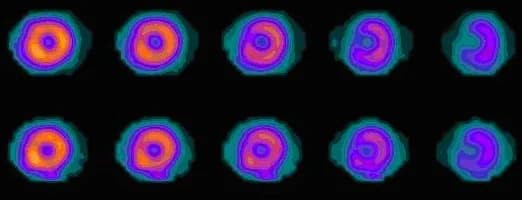 Myocardial perfusion imaging: short-axis slices at stress (top row) and rest (bottom row)