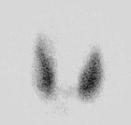 Thyroid scan, anterior view of both thyroid lobes