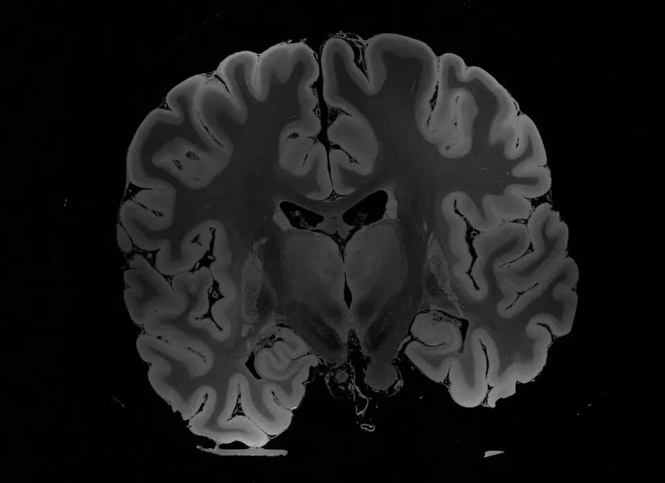 MRI
