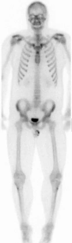 Whole-body bone scan, anterior view