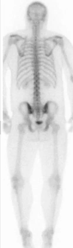 Whole-body bone scan, posterior view