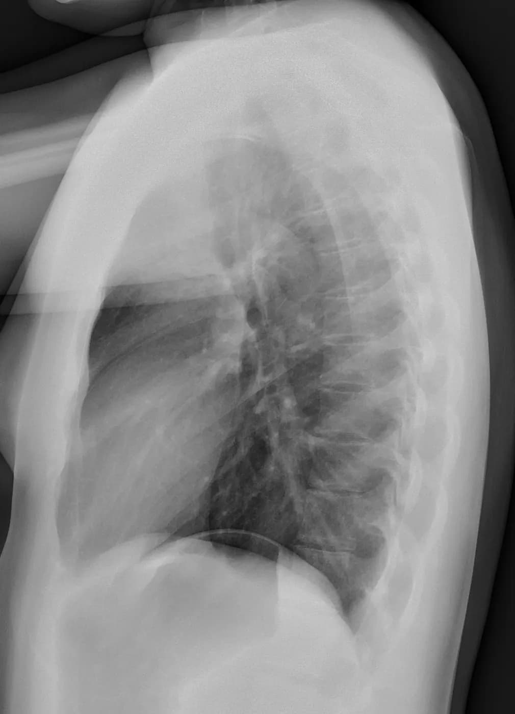 Lateral chest X-ray showing the trachea, retrosternal space, heart, thoracic spine, and diaphragm