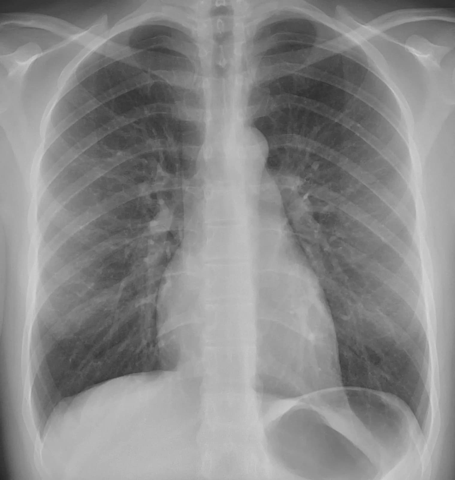 Frontal (PA) chest X-ray showing both lung fields, the heart, the mediastinum, and the diaphragm
