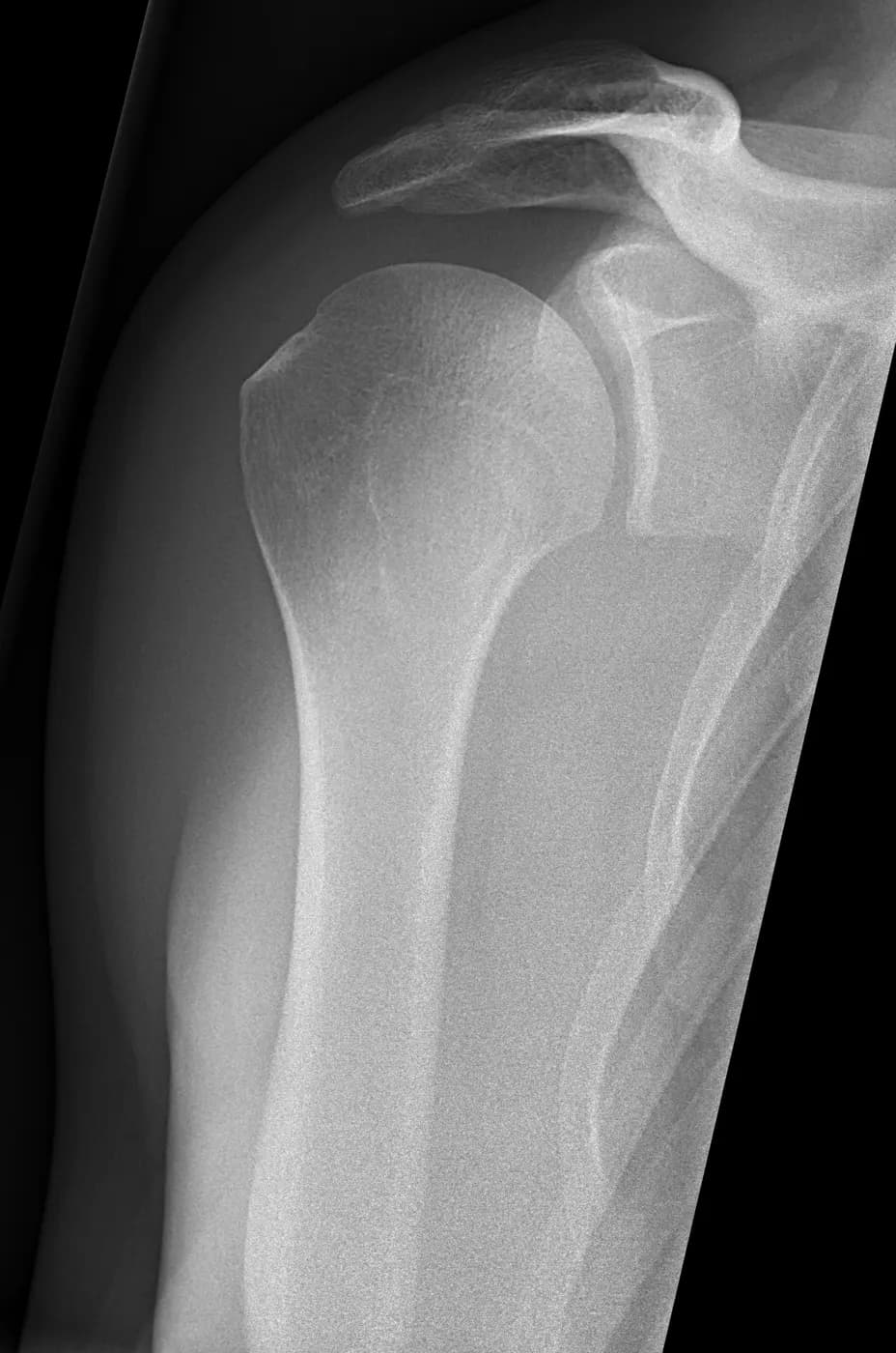 Frontal (Grashey) shoulder X-ray showing the humeral head and acromion